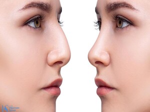 Image of Rhinoplasty