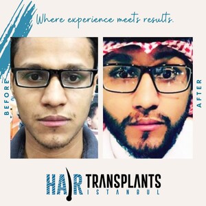 Image of Hair Transplant Istanbul (HTI) Gallery 2