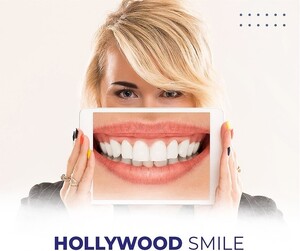 Image of Hollywood smile