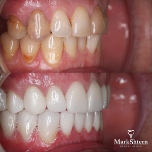 Image of Dental veneers