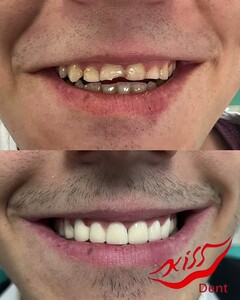 Image of BEFORE & AFTER ZIRCONIA CROWNS