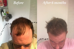 Image of London Hair Transplant Clinic Gallery 0