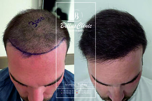 Image of Hair transplant result of our patient from the USA