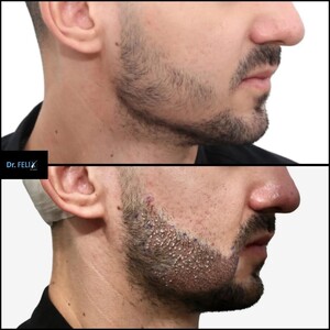 Image of Dr Felix Hair Implant Gallery 3