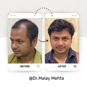 Image of Hair transplant