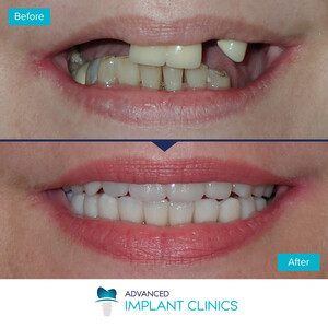 Image of All on 4 dental implants