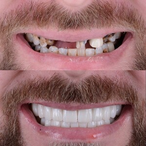 Image of Dental implants