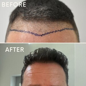 Image of FUE Hair transplant