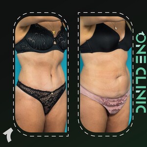 Image of Tummy Tuck - One Clinic