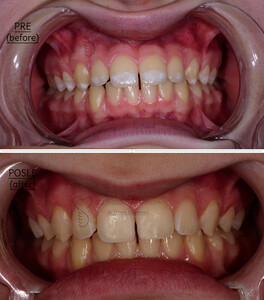 Image of Teeth whitening