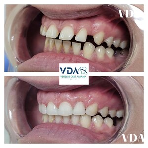 Image of Veneers Dent Albania Clinic Gallery 3