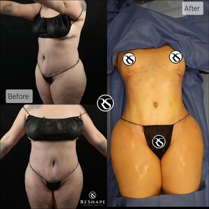 Image of 360 Lipo