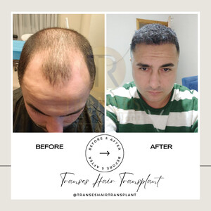 Image of Transes Hair Transplant Gallery 3