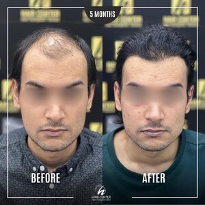 Image of Before and After a Hair Transplant