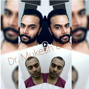 Image of Dr. Mukesh Batra Dermatologist Hair Transplant Gallery 0