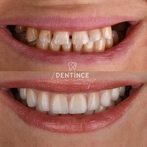 Image of Laminate veneers