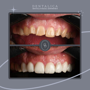 Image of Smile makeover - Dentalica Clinics