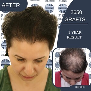 Image of Women's hair transplant