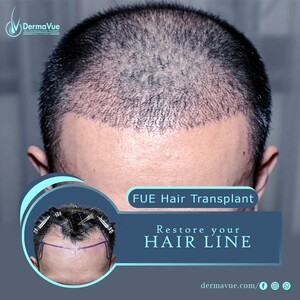 Image of DermaVue Skin, Cosmetology & Hair Transplant Gallery 3