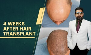 Image of Hair transplant before and after