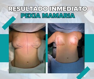 Image of Breast surgery before and after