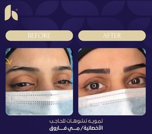 Image of Eyebrow hair transplant - Al Hokail Medical Center