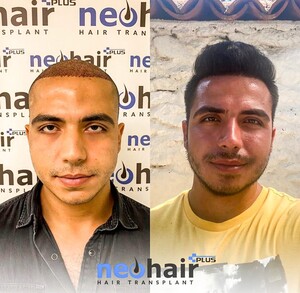 Image of NeoHair Plus Hair Transplant Gallery 2