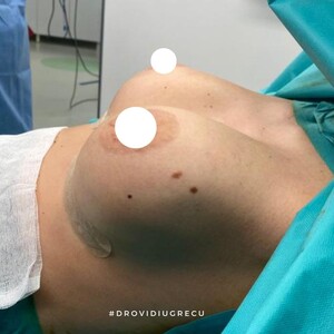 Image of Breast implants