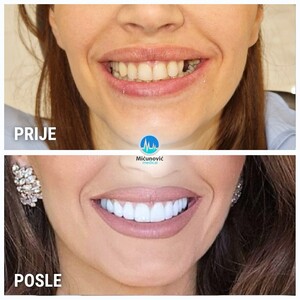 Image of Hollywood smile, Micunovic medical