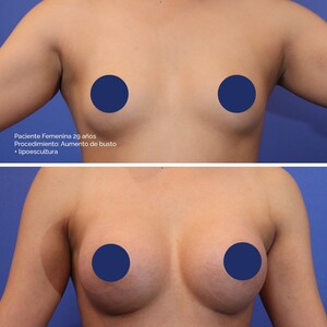 Image of Breast augmentation