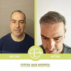 Image of Esteda Hair Hospital - Hair Transplant Turkey Gallery 0