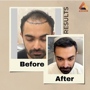 Image of Hair Transplantation Before and After