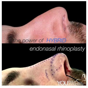 Image of Rhinoplasty before and after