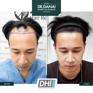 Image of BEQ Clinic - Dr. Danai Bangkok Hair Transplant Gallery 2