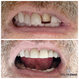 Image of Dental treatments - Göcek Dent