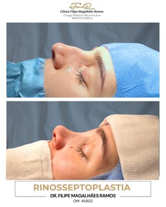 Image of Rhinoplasty - FMR Clinic 