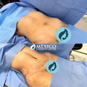 Image of Tummy tuck