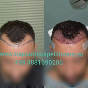 Image of Trapianto capelli Tirana Gallery 2