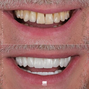 Image of Dental implants and crowns