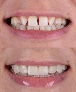 Image of Veneers