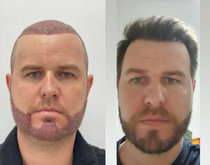 Image of Sercan Aslan Hair Transplant Turkey Gallery 1