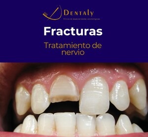 Image of Dental fracture