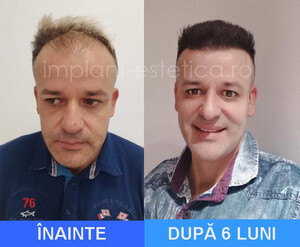 Image of Hair Implant Center Cluj Gallery 0