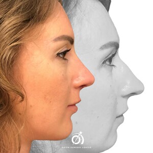 Image of Rhinoplasty Orion Surgery Center