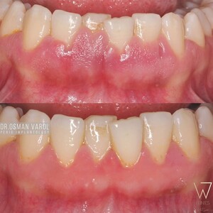 Image of Gum treatment