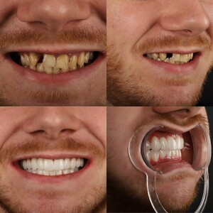 Image of Hollywood smile