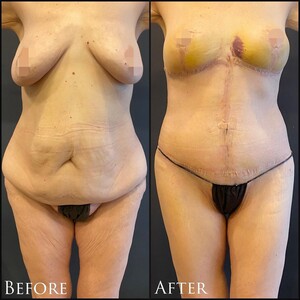 Image of Body lift before and after