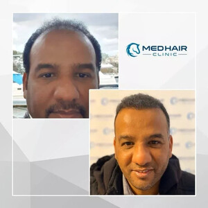 Image of Medhair Clinic Hair Transplant Gallery 2