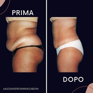 Image of Liposuction