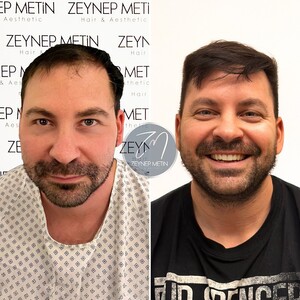 Image of DHI Hair transplant